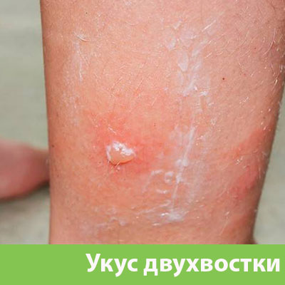 Укус двухвостки в Березниках