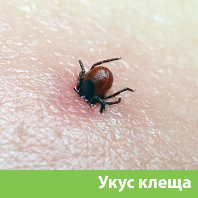 Укус клеща в Березниках