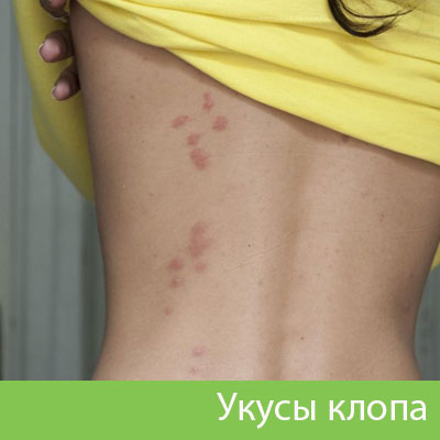 Профессиональное уничтожение клопов в Березниках